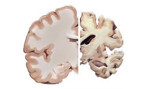 Imagem ilustrativa do cérebro saudável (E) e o atingido pelo mal de Alzheimer, que leva a deterioração da memória e de outras faculdades intelectuais (foto: Max Res / Divulgação )