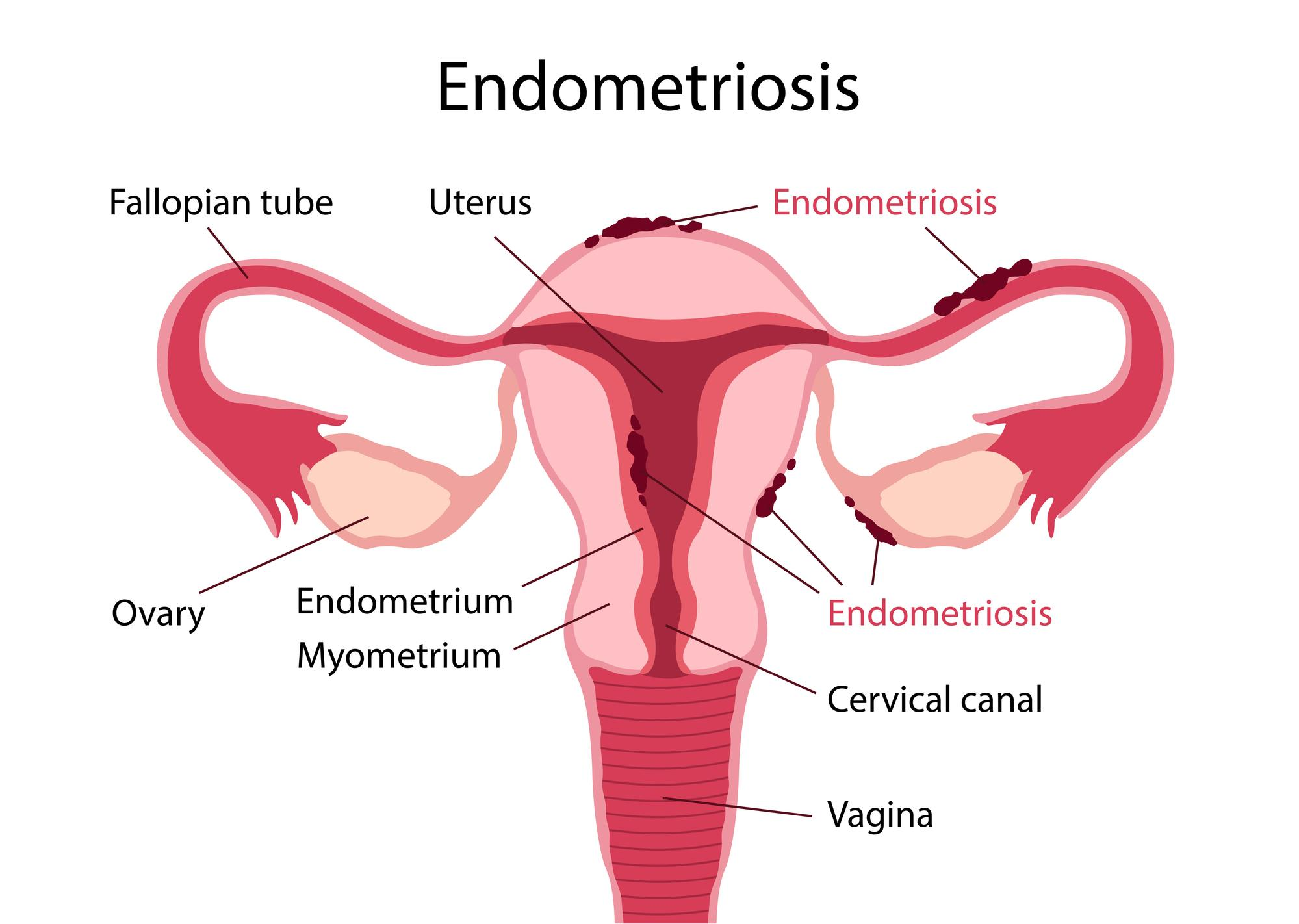 endometriose mapa